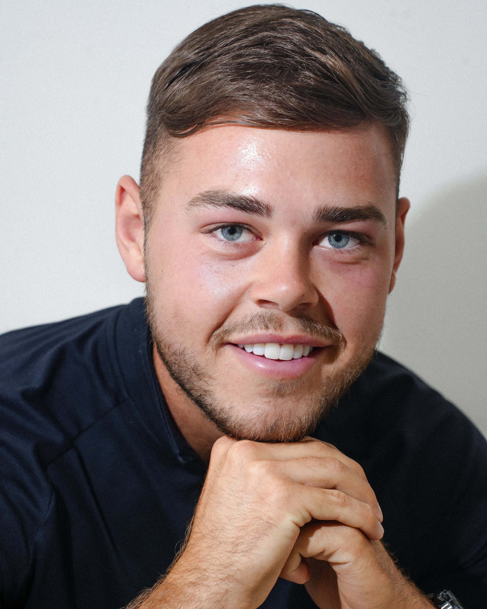 Patient result after completing aligner treatment